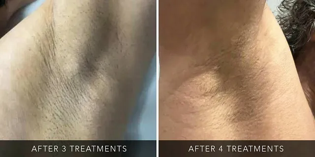 Laser Hair Removal