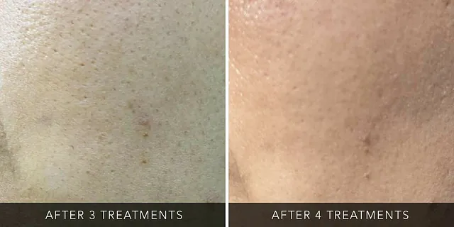 Laser Hair Removal